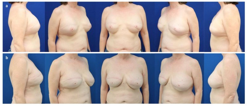 After mastectomy