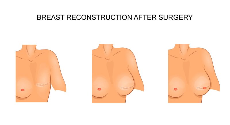 Breast plastic