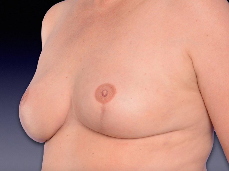 Breast reconstruction