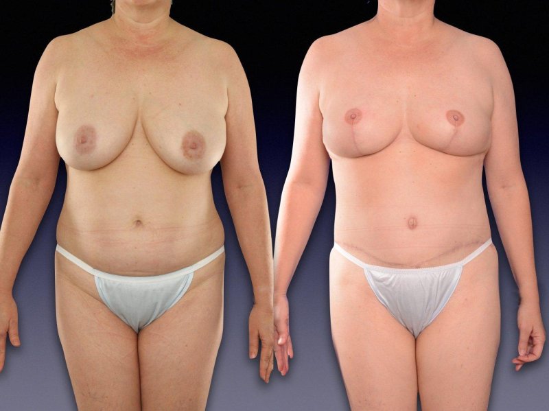 Women after Mastectomy Naked